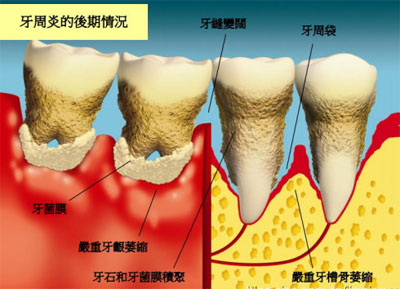 二级松动牙齿必须拔吗,老年狗牙齿松动要拔吗