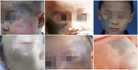 青胎记分哪几类,青胎记容易癌变吗