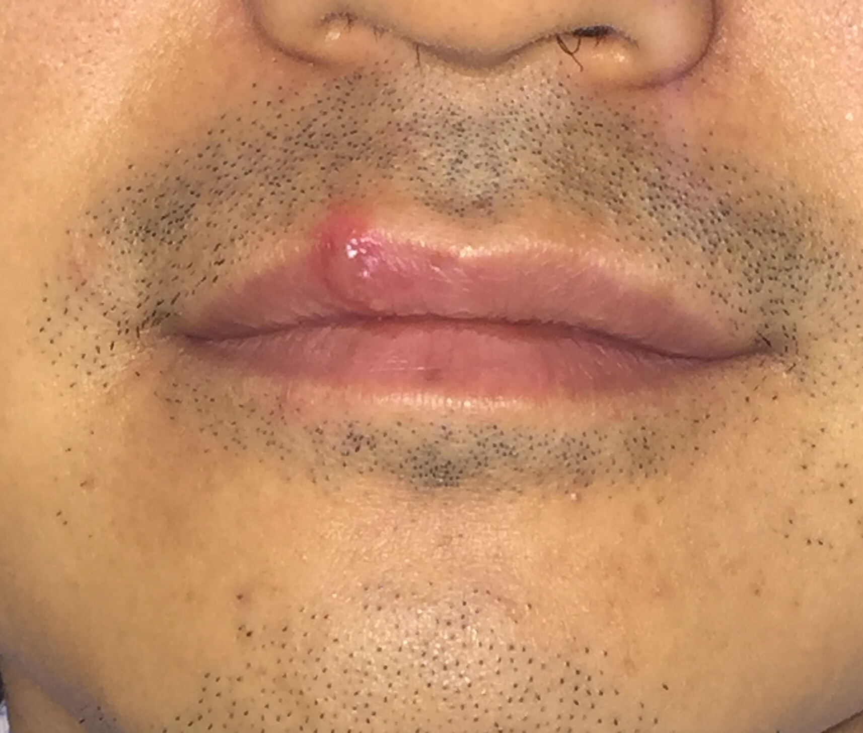 熬夜之后嘴唇上起小水泡,熬夜过后嘴巴里的血泡怎么办