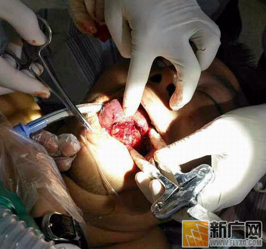 男子突发癫痫咬舌民警帮搓手,癫痫咬断舌头