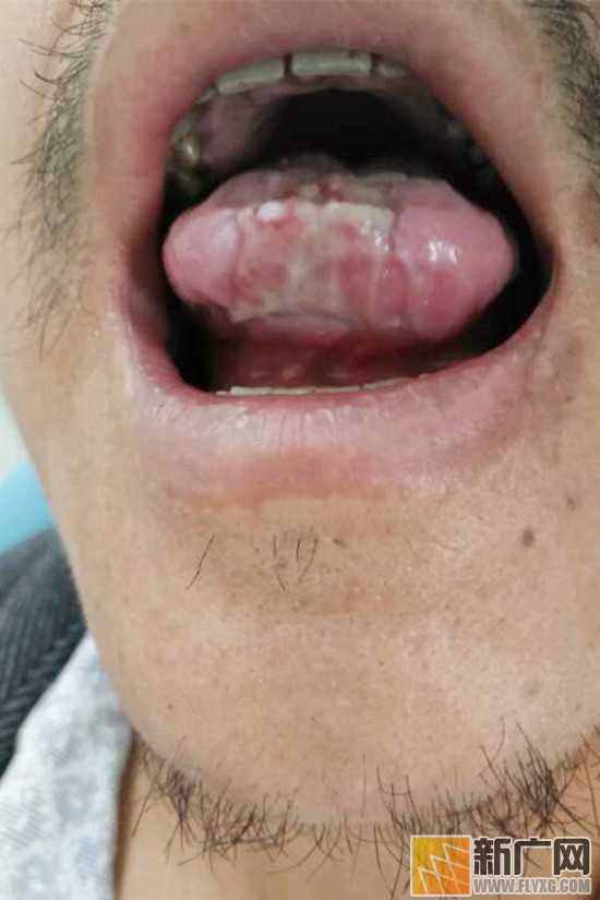 男子突发癫痫咬舌民警帮搓手,癫痫咬断舌头