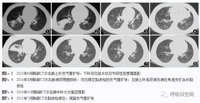 变态反应性支气管肺曲霉病,儿童变应性支气管肺曲霉病