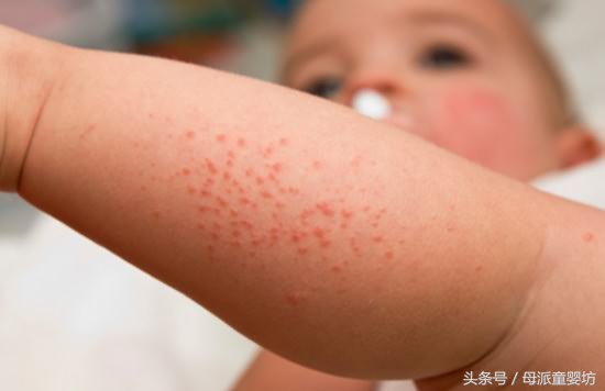 湿疹妈妈要注意什么,宝宝冬季干性湿疹涂什么药