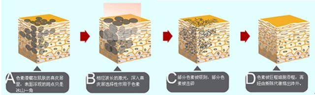 皮肤美容激光科主任韩昱华：为什么单纯激光祛斑效果不好？