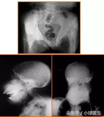 继发性甲状旁腺功能亢进是什么病,继发性甲状旁腺功能亢进怎么治