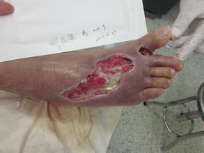 糖尿病并发症一旦产生,药物治疗很难逆转