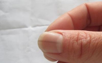 哪种皮肤病容易引起指甲损害,哪些皮肤病会出现指甲的病变