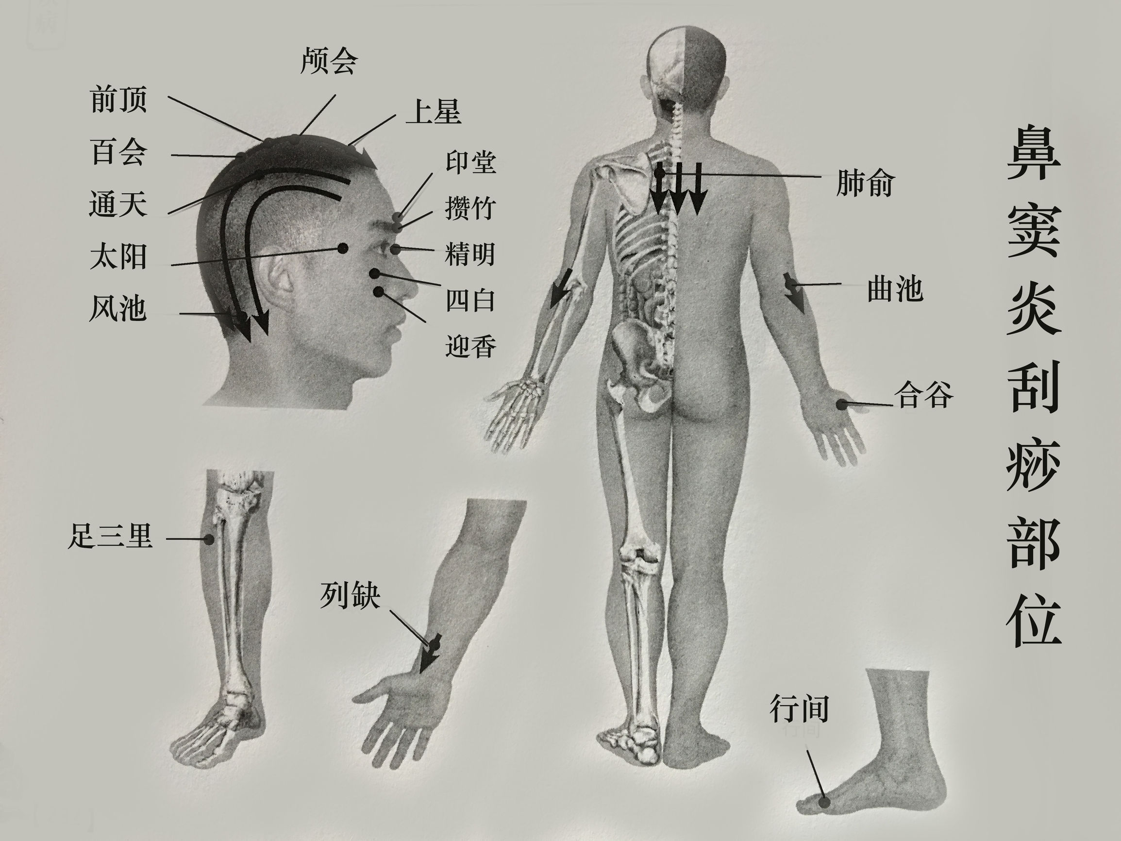 慢性鼻窦炎刺血选哪些穴位,慢性鼻窦炎灸哪个穴位