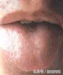 中医舌诊图谱100例,靠谱中医史上最全高清舌诊图谱