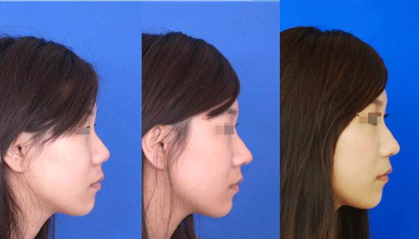 隆鼻手术做得再好也经不住瞎折腾,各种隆鼻手术方法究竟孰优孰劣