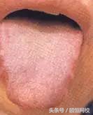 中医舌诊图谱100例,靠谱中医史上最全高清舌诊图谱