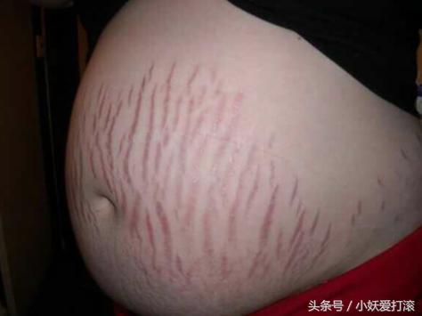 屁股也长妊娠纹,孕中期长妊娠纹用什么祛妊娠纹