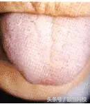 中医舌诊图谱100例,靠谱中医史上最全高清舌诊图谱