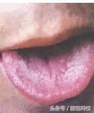 中医舌诊图谱100例,靠谱中医史上最全高清舌诊图谱