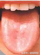 中医舌诊图谱100例,靠谱中医史上最全高清舌诊图谱