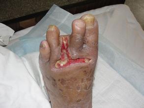 糖尿病并发症一旦产生,药物治疗很难逆转