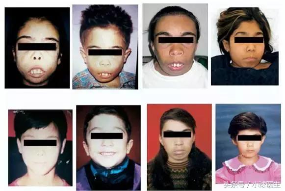 继发性甲状旁腺功能亢进是什么病,继发性甲状旁腺功能亢进怎么治