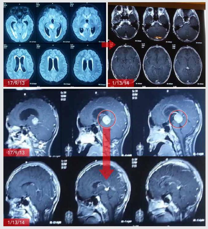电场疗法挽救脑胶质瘤患者--著名瑞士自行车赛冠军罗伯特