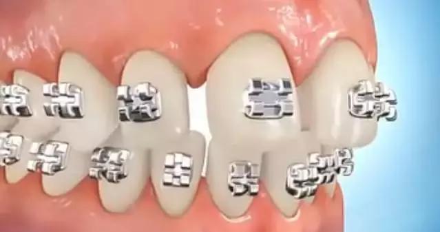 牙缝大矫正多少钱,小孩牙缝大怎么矫正