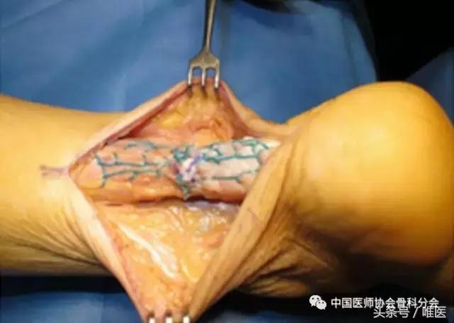 陈旧性跟腱断裂手术修复方法,跟腱断裂陈旧