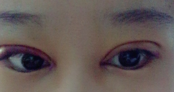 双眼皮手术第五天碰到水怎么办,双眼皮手术前感冒了怎么办