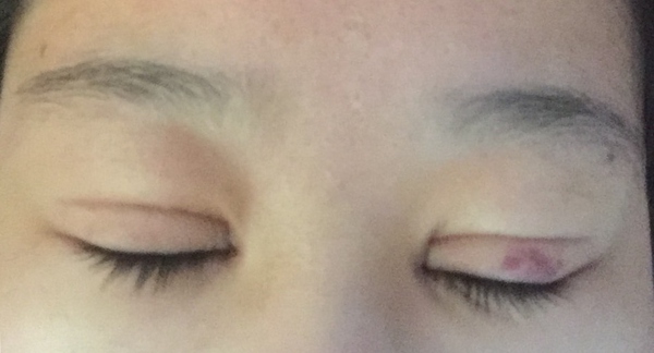 双眼皮手术第五天碰到水怎么办,双眼皮手术前感冒了怎么办