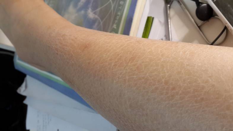 不做冬天的美人鱼！皮肤干燥、起鳞屑、痒痒痒，怎么治？