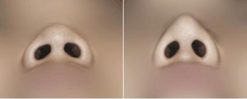 隆鼻手术做得再好也经不住瞎折腾,各种隆鼻手术方法究竟孰优孰劣