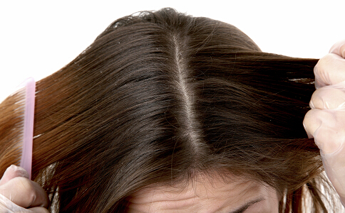 女生头皮屑怎么去除小妙招,女人头皮屑多怎么去除最简单方法