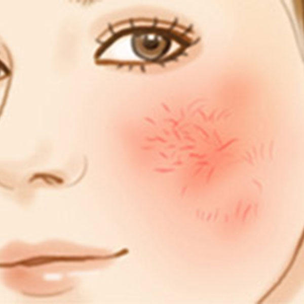 红血丝敏感肌知识,红血丝小妙招