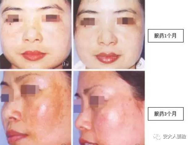 美白丸美白饮真的有效果吗,什么牌子的美白丸最有效果