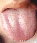 中医舌诊图谱100例,靠谱中医史上最全高清舌诊图谱