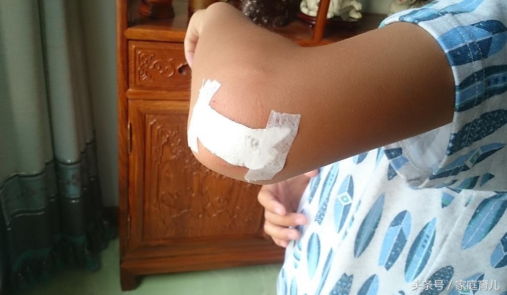 宝宝擦伤破皮出血需要打破伤风吗,宝宝蹭破皮流血怎么处理
