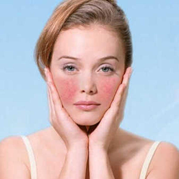 红血丝敏感肌知识,红血丝小妙招