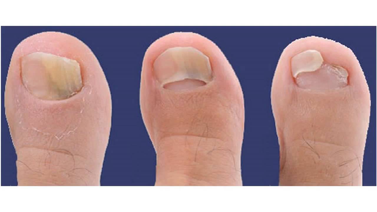 哪种皮肤病容易引起指甲损害,哪些皮肤病会出现指甲的病变