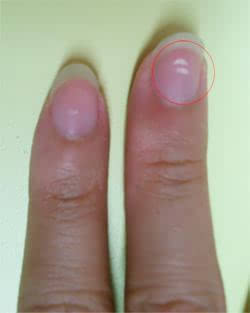 哪种皮肤病容易引起指甲损害,哪些皮肤病会出现指甲的病变