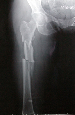 肋骨骨折是手术好还是不手术好,骨折错过了手术时间还能手术吗