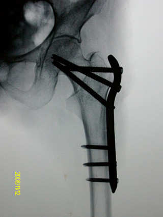 肋骨骨折是手术好还是不手术好,骨折错过了手术时间还能手术吗