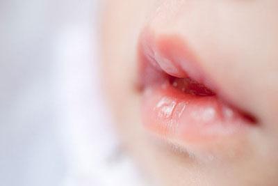 很多婴儿小孩长鹅口疮,父母却都不知道,所有鹅口疮知识全在这里