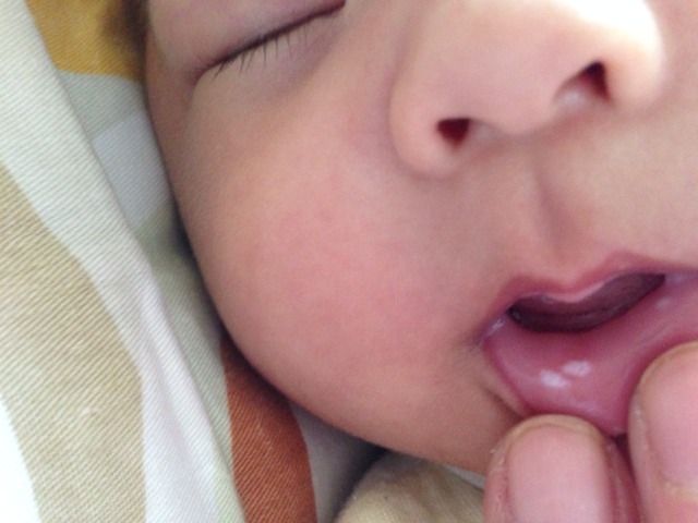 很多婴儿小孩长鹅口疮,父母却都不知道,所有鹅口疮知识全在这里