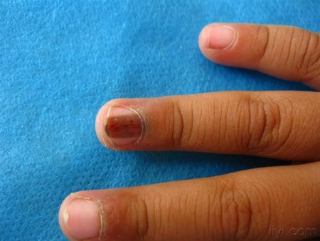 哪种皮肤病容易引起指甲损害,哪些皮肤病会出现指甲的病变