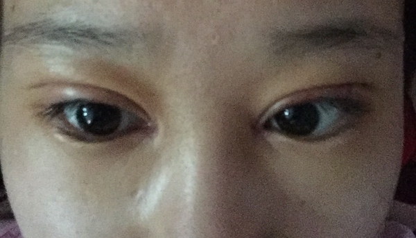 双眼皮手术第五天碰到水怎么办,双眼皮手术前感冒了怎么办