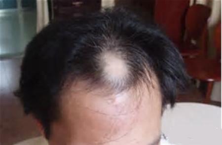 头皮屑脂溢性皮炎中药疗法,头皮脂溢性皮炎中医治疗