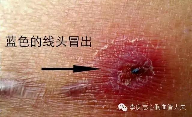 心脏搭桥术后康复和注意事项,心脏搭桥术后可能存在的问题