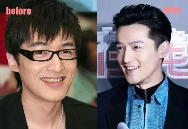 整牙=整容？看杨幂、刘涛、高圆圆为你亲身示范！