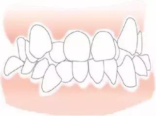 牙套黑三角要不要片切,戴牙套会出现黑三角后怎么恢复