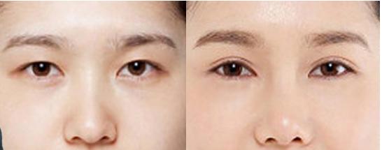 鼻子整形保质期多久,整形维护期大概是多久