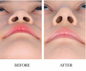 鼻子整形保质期多久,整形维护期大概是多久