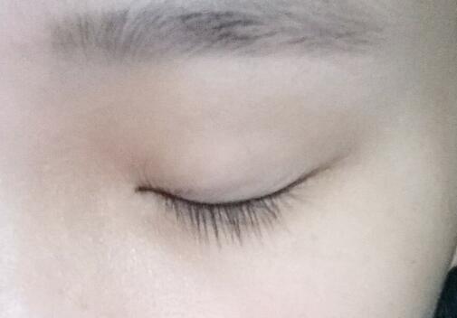 服用盐酸厄洛替尼片饮食禁忌 (吃厄洛替尼片有什么副作用)