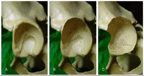髋臼底严重骨缺损怎么翻修,髋臼骨缺损2厘米能愈合吗